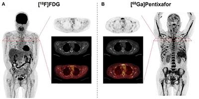 Molecular Imaging in Multiple Myeloma—Novel PET Radiotracers Improve Patient Management and Guide Therapy